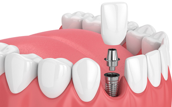 The Top 10 Benefits Of Dental Implants